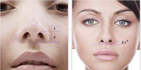 Bật mí hai phương pháp sửa mũi hếch