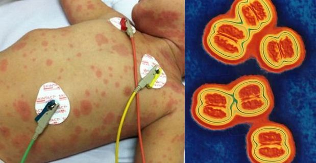 Những điều cần biết để phòng tránh bệnh viêm não mô cầu đang có nguy cơ bùng phát