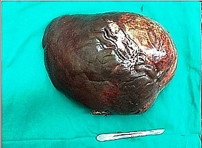 Cắt bỏ khối u gan nặng 5 kg cho bệnh nhân mắc bệnh lý hiếm gặp trên thế giới