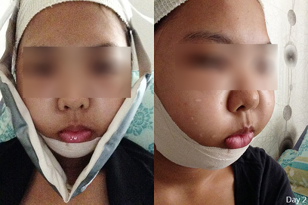 Báo động độ tuổi thực hiện phẫu thuật thẩm mỹ tại Singapore