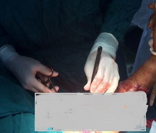 Hải Phòng: Một ngư dân bị cá mập cắn nát cánh tay phải