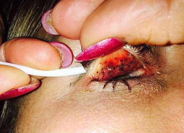 Người phụ nữ suýt mù chỉ vì thích làm đẹp nhưng lười tẩy trang