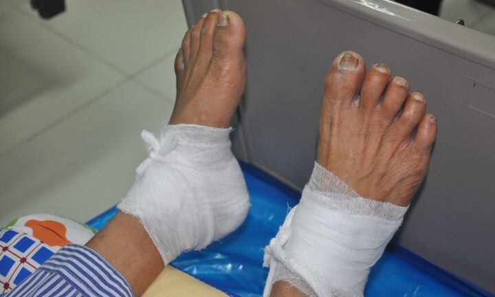 Bỏng nặng do chườm nóng bằng...ngải cứu