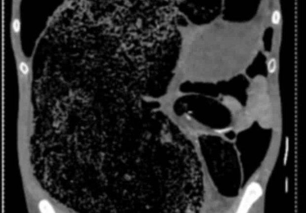 Người đàn ông suýt mất mạng vì táo bón