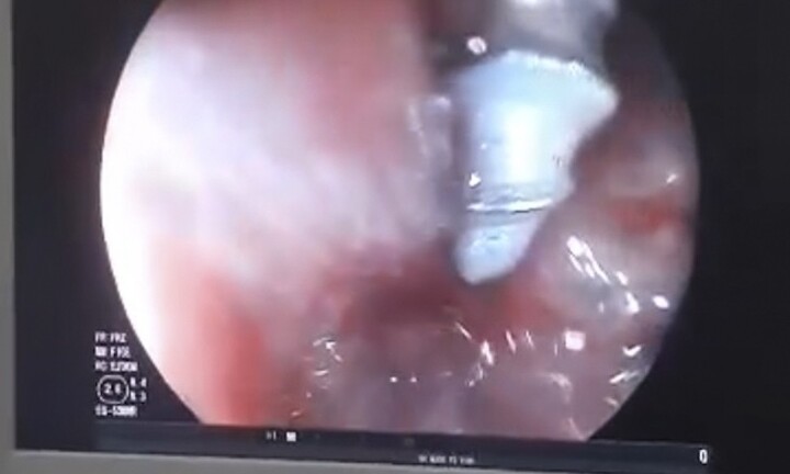 Bé gái 2 tuổi vô tình nuốt chiếc đinh xoắn ốc vào dạ dày