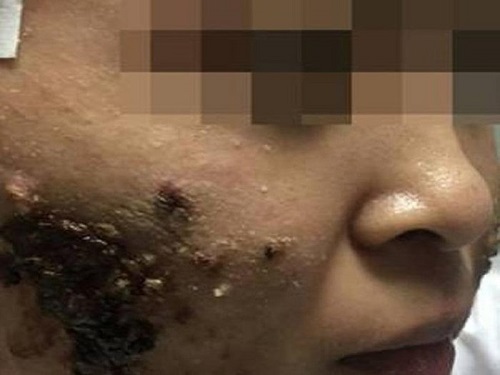 Kinh hoàng mụn trứng cá như mảng cơm cháy trên gương mặt của cô gái trẻ