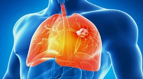 Những thực phẩm có thể loại bỏ độc tố, giúp lá phổi khỏe từ trong ra ngoài