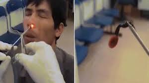 Video: Sởn da gà đỉa sống trong mũi người đàn ông ở Việt Nam