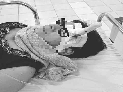 Bị dao gọt hoa quả đâm xuyên não vì trượt chân ngã khi cạo vôi tường