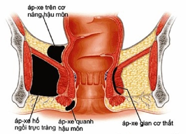 Mối nguy hiểm từ những căn bệnh... khó nói
