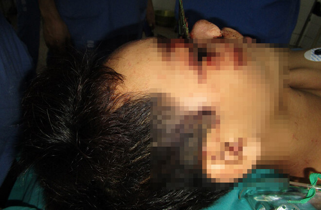 Đang làm việc, nam thanh niên bị lưỡi cưa 12cm găm sâu vào mặt