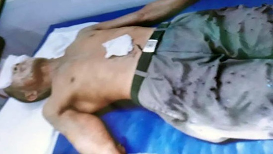 Tin tức pháp luật mới nhất ngày 5/8/2018: Hai người đàn ông bị tạt axit bỏng nặng