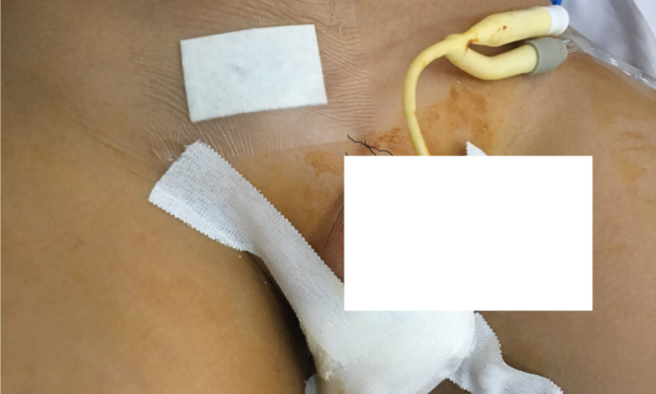 Giật mình thấy thanh sắt xuyên từ bụng xuống tầng sinh môn