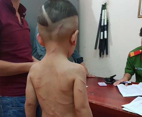 Tin tức pháp luật mới nhất ngày 17/8/2018: Bé trai 3 tuổi bị gã cha dượng đánh đập dã man