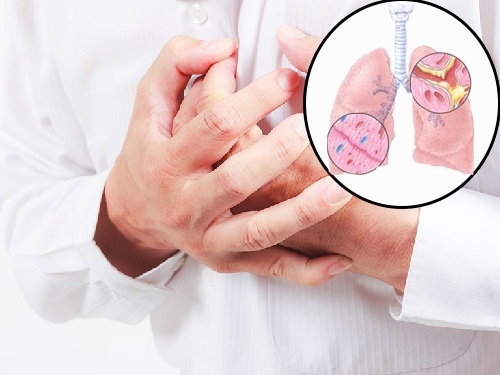 Những dấu hiệu nhận biết ung thư phổi thường bị bỏ qua
