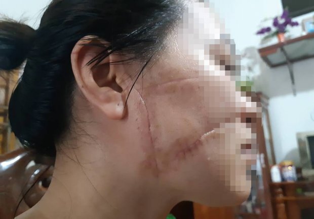Vụ vợ tố chồng cắt gân, rạch mặt: Người chồng thừa nhận toàn bộ hành vi