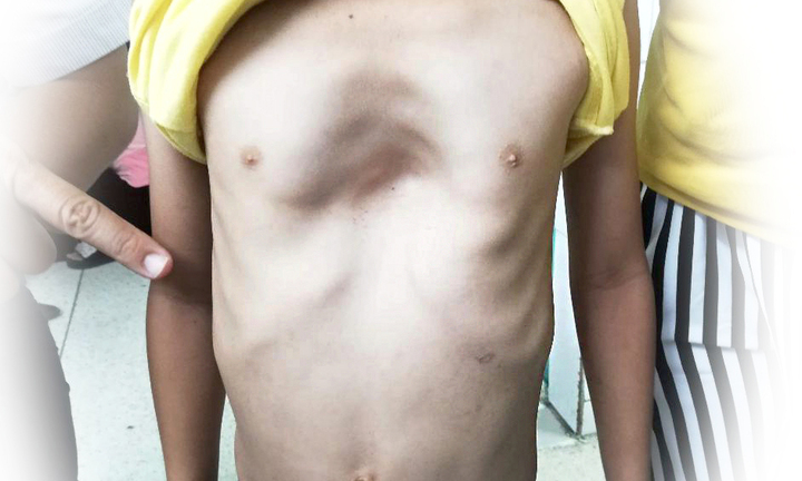 Hiếm gặp ca bệnh cháu bé bị ngực lõm 