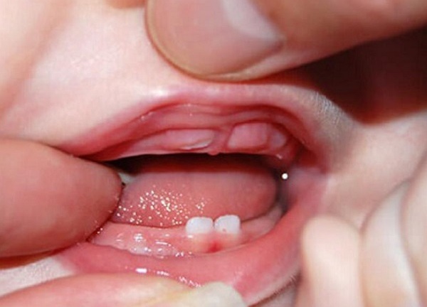 Làm gì khi trẻ biếng ăn do mọc răng?