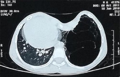 Bé trai 7 tuổi lõm ngực, mang nang phổi khổng lồ kèm khiến tim bị đẩy sang bên phải