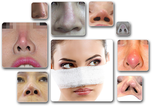 Chuyên gia tại Thẩm mỹ viện D’Vincy nói gì về phẫu thuật thẩm mỹ mũi hỏng?