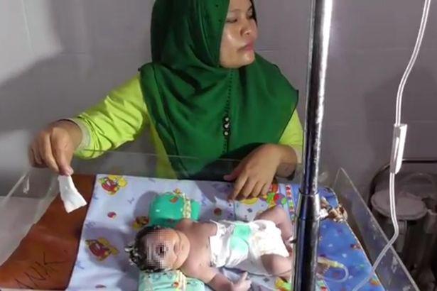 Bố mẹ suýt ngất khi thấy con chào đời chỉ có một mắt giữa trán