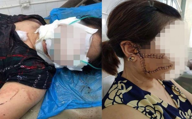 Tin tức đời sống mới nhất ngày 20/9/2018: Tâm sự cay đắng của người vợ bị chồng cắt đứt gân chân