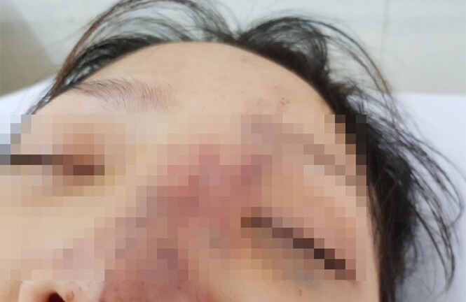 Tiêm filler giá rẻ ở spa, thiếu nữ có nguy cơ mù mắt