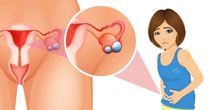 U nang buồng trứng có nguy hiểm không? Sử dụng thảo dược Nga Phụ Khang để không còn nỗi lo về bệnh