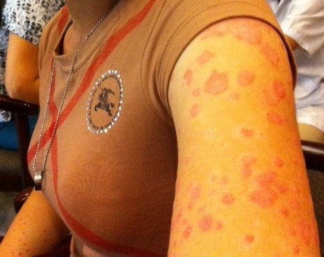 Bảo Thanh Đường: Thuốc đặc trị chữa bệnh vẩy nến