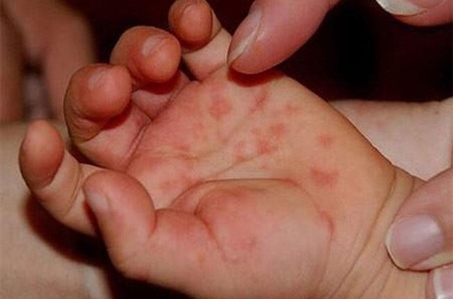 Dịch tay chân miệng tăng đột biến, mẹ cần làm gì để phòng bệnh cho trẻ?