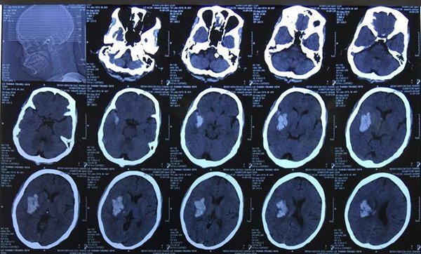 Tin tức đời sống mới nhất ngày 3/10/2018: Cắt phăng mảnh sọ cứu bệnh nhân chảy máu não ồ ạt