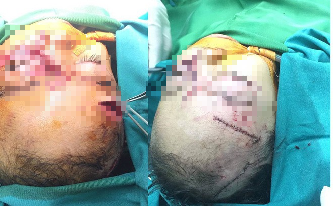 Bé gái 31 tháng tuổi bị chó nhà nuôi cắn nhiều nhát vào mặt