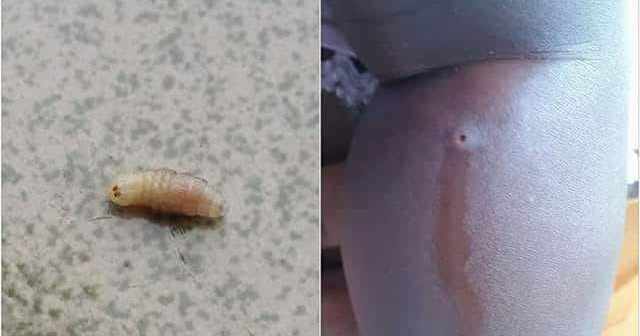 Tin tức đời sống mới nhất ngày 12/10/2018: Người mẹ nặn ra 4 con giòi sống trên cơ thể con trai
