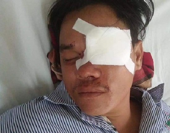 Khởi tố đối tượng đâm mù mắt 