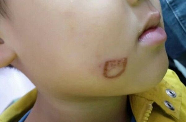 Học sinh không nghe lời, giáo viên mầm non dùng bật lửa đốt má cậu bé