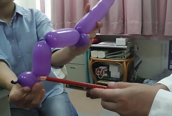 Hy hữu: Cụ ông U60 bị gãy