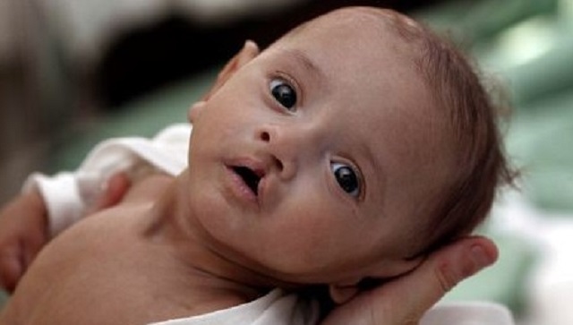 Bị cúm khi mang bầu sẽ khiến con sinh ra bị sứt môi: Đúng nhưng chưa đủ