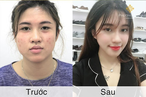 Miếng dán định hình mặt V-line có thực sự thần thánh như quảng cáo?