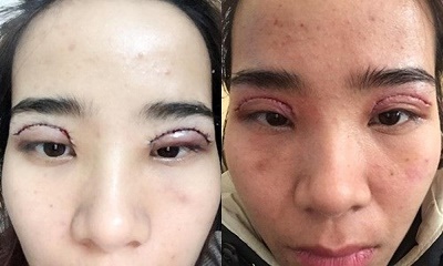 Những biến chứng có thể xảy ra sau cắt mí và cách khắc phục