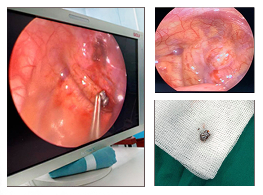 Đạn súng săn xuyên từ cổ xuống phổi