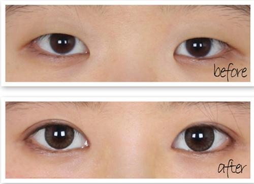 Thẩm mỹ quốc tế VQ: Mang đến điều “kỳ diệu” cho đôi mắt của bạn