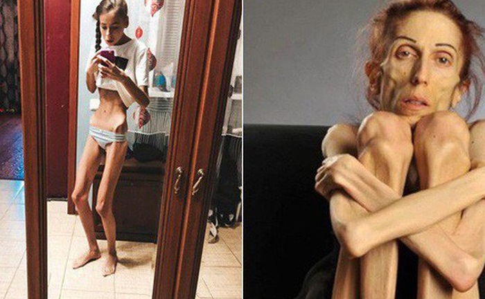 Tin tức đời sống mới nhất ngày 9/12/2018: Hai chị em sinh đôi nằm chờ chết vì nhịn đói giảm cân