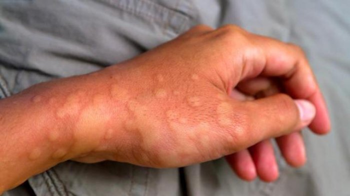 Dị ứng thời tiết, căn bệnh có thể gây chết người vào mùa đông