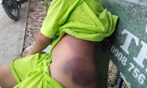 Kỷ luật cô giáo đánh học sinh lớp 1 bị bầm tím