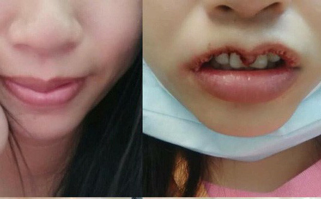 Tin tức đời sống mới nhất ngày 23/12/2018: Sẹo co kéo, không khép được miệng vì phẫu thuật môi trái tim