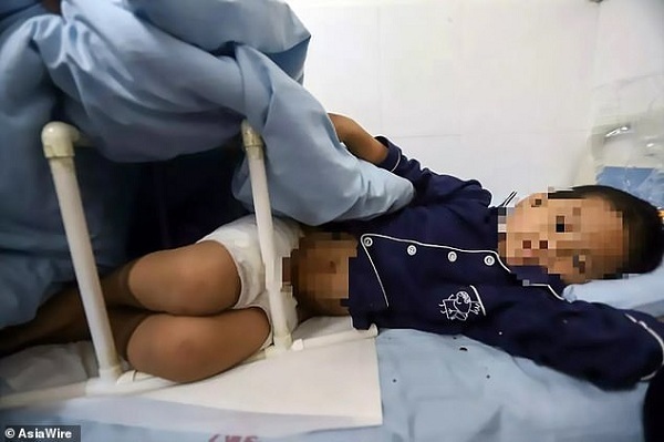 Mẹ kế bị tố đổ nước sôi lên bộ phận sinh dục của con chồng để trừng phạt