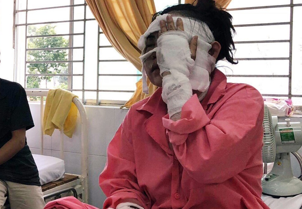 Cô gái bị tạt axit hỏng 2 mắt trước ngày cưới: Tại sao lại ra tay tàn độc với tôi như vậy?