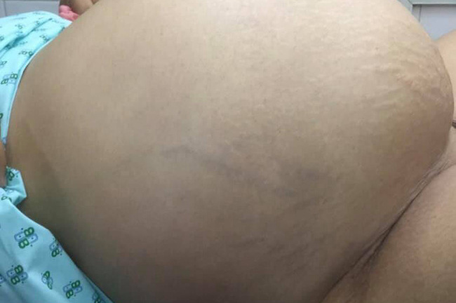 Tin tức đời sống mới nhất ngày 4/1/2019: Người phụ nữ khổ sở vì khối u lớn
