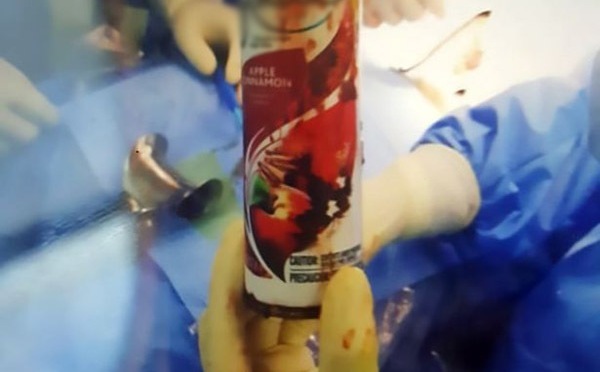 Tin tức đời sống mới nhất ngày 7/1/2019: Bình xịt phòng mắc kẹt trong trực tràng nam bệnh nhân
