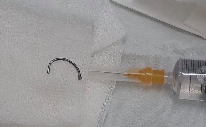 Đáng sợ người đàn ông bị đinh cong dài 2,5 cm cắm sâu trong mắt